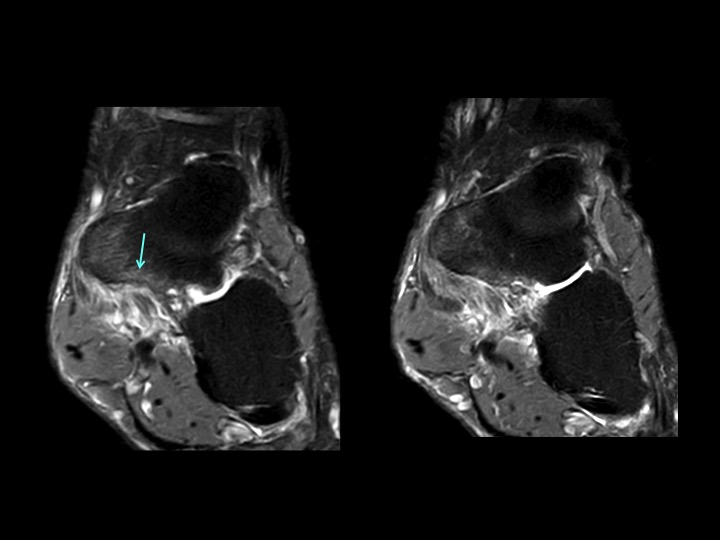 Figure 4 for case posterior tibial tendon ( RID3194 )